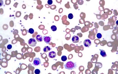MDM2 Gen Polymorphisms at Acute Myeloid Leukemia Patients
