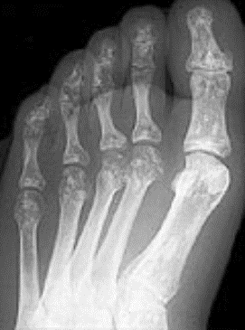 Is it Possible to Expedite Studies on the Effects of Pharmacological Agents on Primary Cell Cultures Obtained from High-grade Fibular Osteosarcoma?