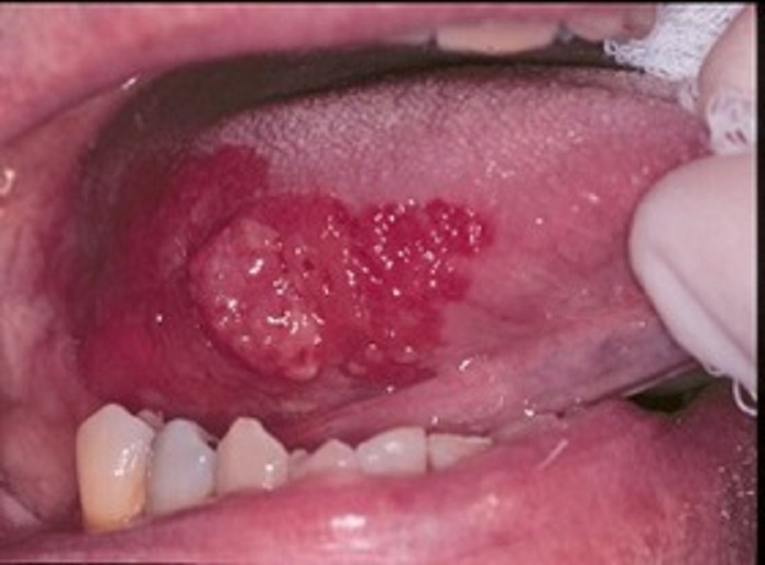 Rho-Kinases in Oral Squamous Cell Carcinoma: A Review