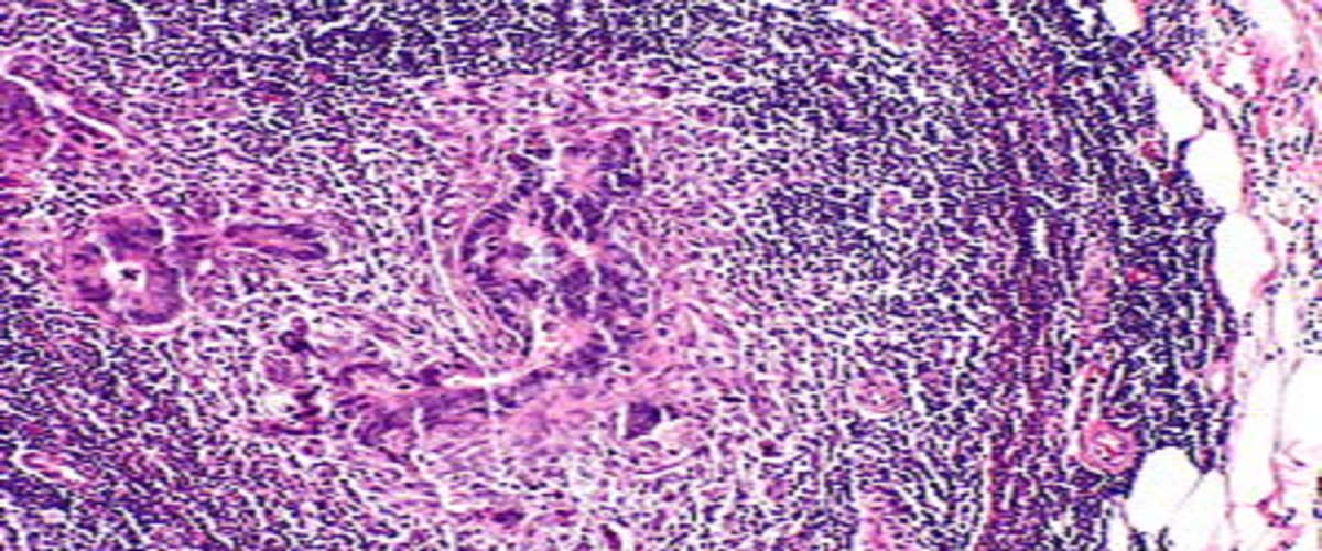 Lymphoepithelioma-Like Carcinoma of the Uterine Cervix - Reporting Three Rare Clinical Cases with Lymph Node Metastasis