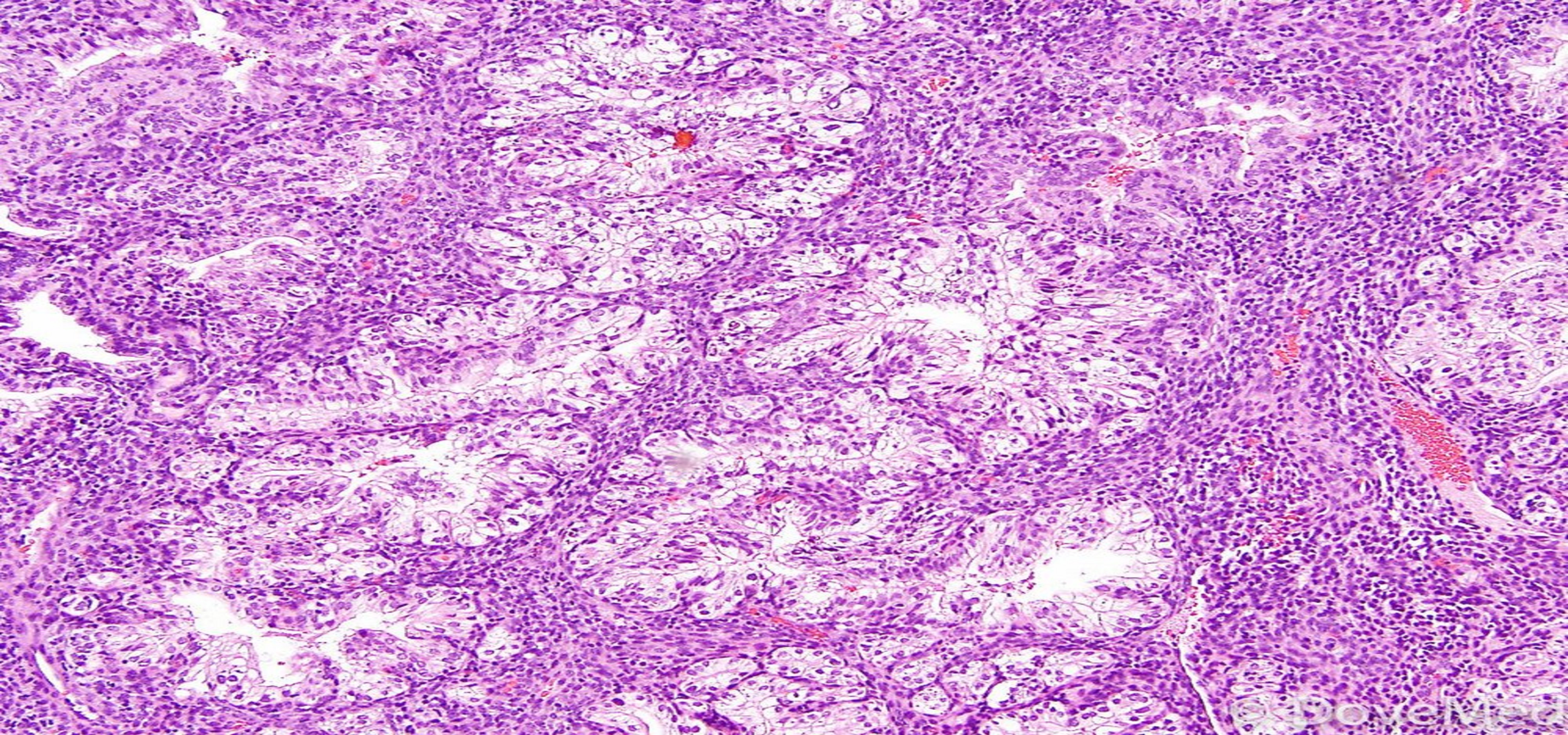 Prognostic Implications of Hyaluronic Acid Binding Protein 1 (HABP1) Expression, Estrogen Receptor (ER) and Progesterone Receptor (PR) Loss in Endometrial Carcinoma