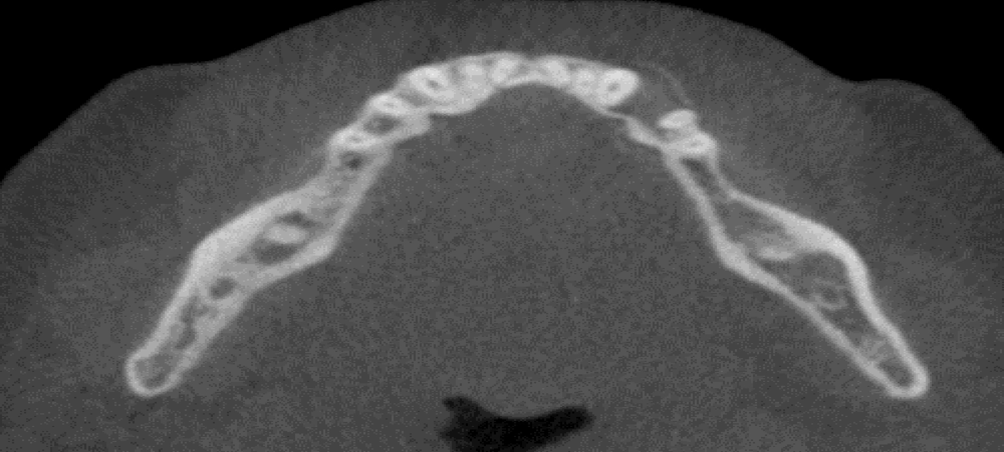 The Clinical Presentation of Odontogenic Myxoma of the Jaws: A 22-Year Retrospective Analysis