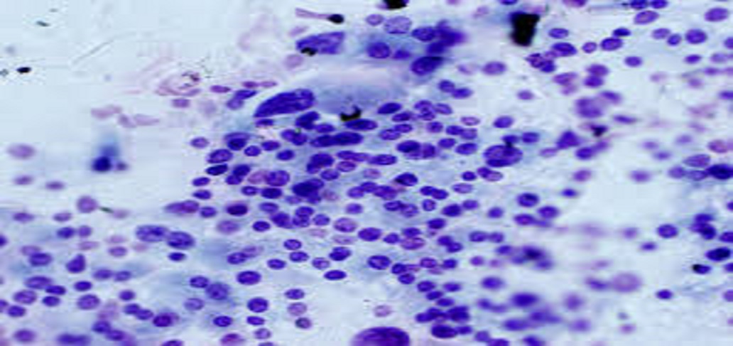Management of Thyroid Nodules with Atypical Cytology on Fine-Needle Aspiration with Ultra Sonogram