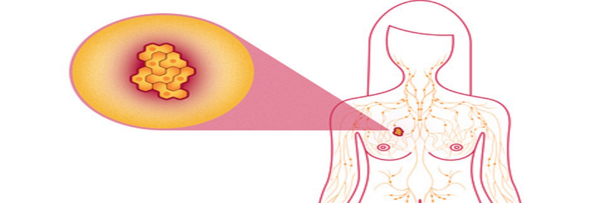 Trastuzumab Resistance: What Are We Offering to Breast Cancer Patients?