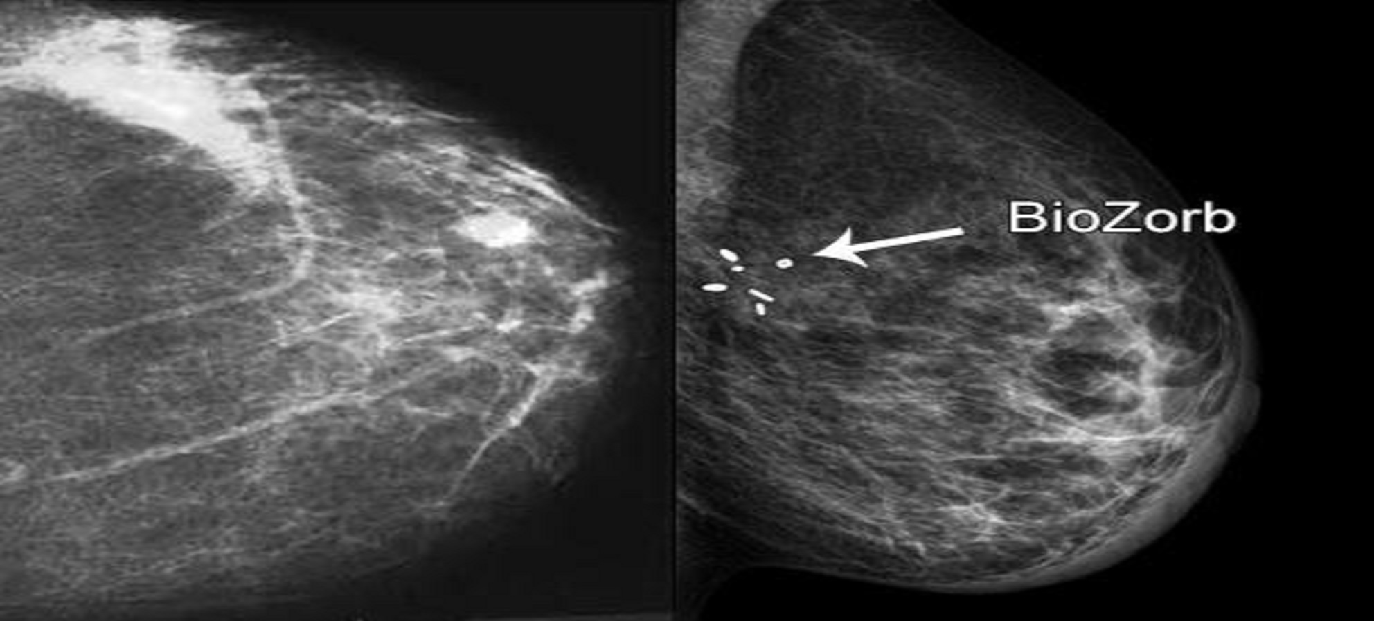 A Feasible Novel Technique for Breast Cancer Imaging Using UWB-Microwave Antennas