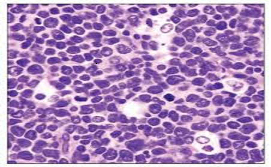 Mantle Cell Lymphoma Misdiagnosed as Chronic Lymphocytic Leukemia: Optimization of Diagnostic Approach