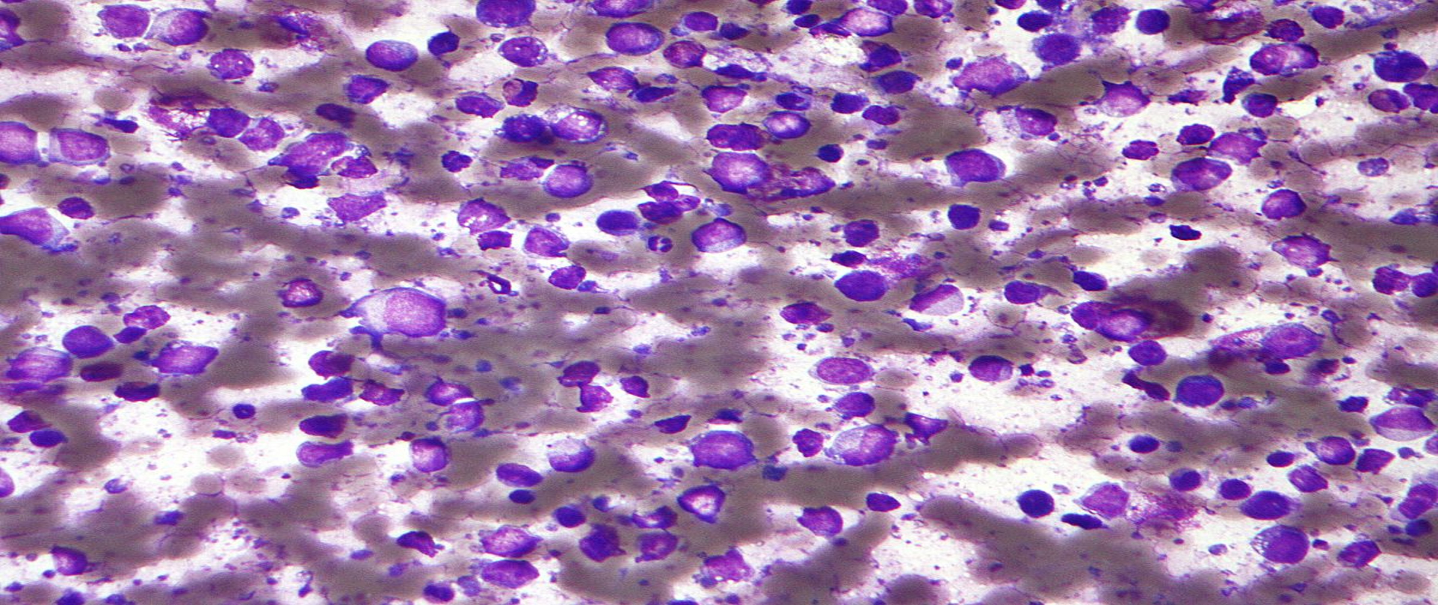 Successful Treatment of a Progressive Primary Cutaneous Diffuse Large B-Cell Lymphoma of the Leg (PCLBCL-LT) with Hyperthermic Isolated Limb Perfusion