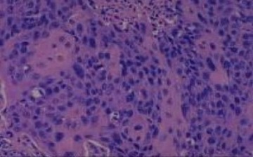 Warty Carcinoma of the Uterine Cervix with Lymph Node Metastasis: A Case Report with a Literature Review