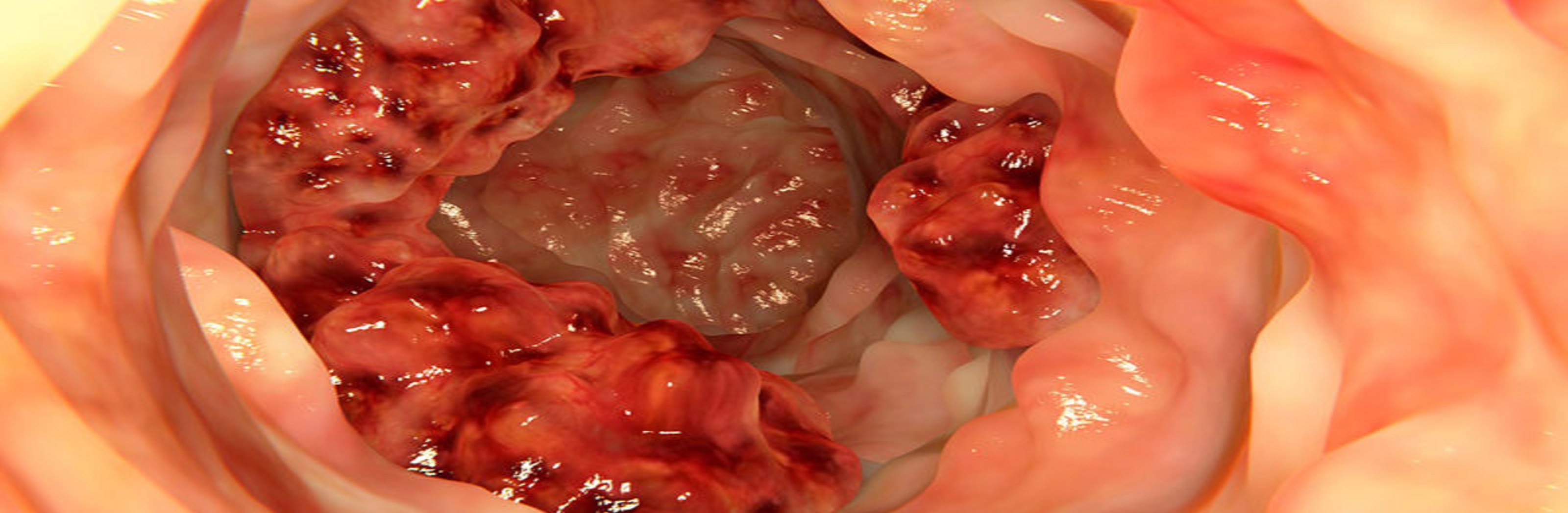Prognostic Model of Stage II/III Colon Cancer Constructed using Gene Expression Subtypes and KRAS Mutation Status