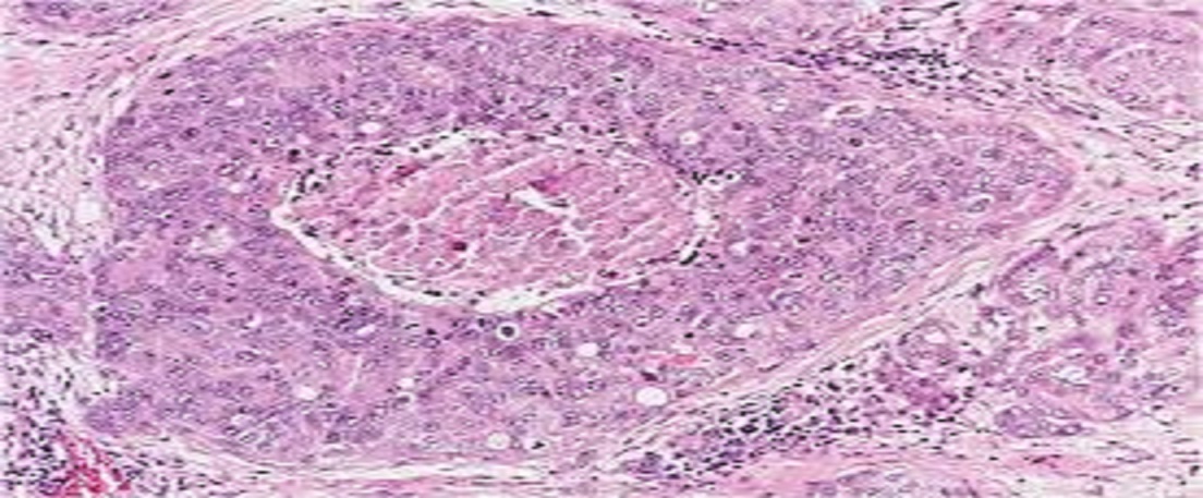 The Value of FAK and SLUG Expression in Patients with Breast Carcinoma and Relation of Their Expression to Clinicopathological and Prognostic Parameters