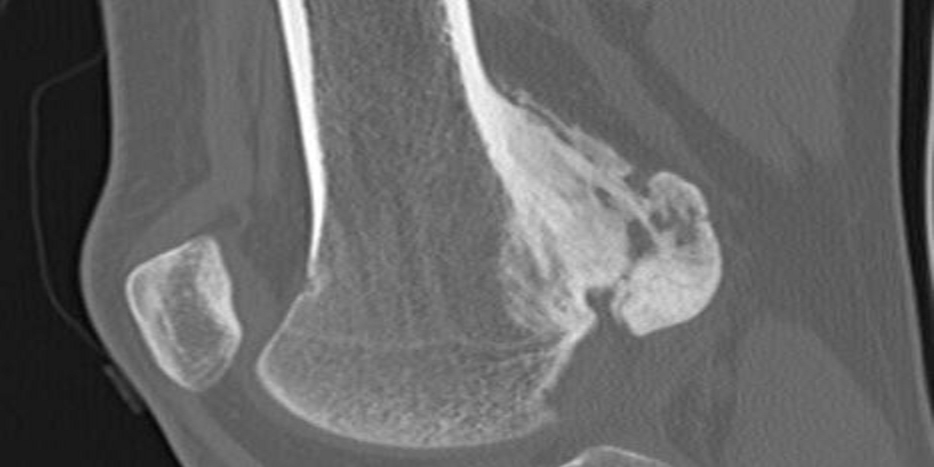 Prognostic Markers in Osteosarcoma Patients in the Najaf Province of Iraq