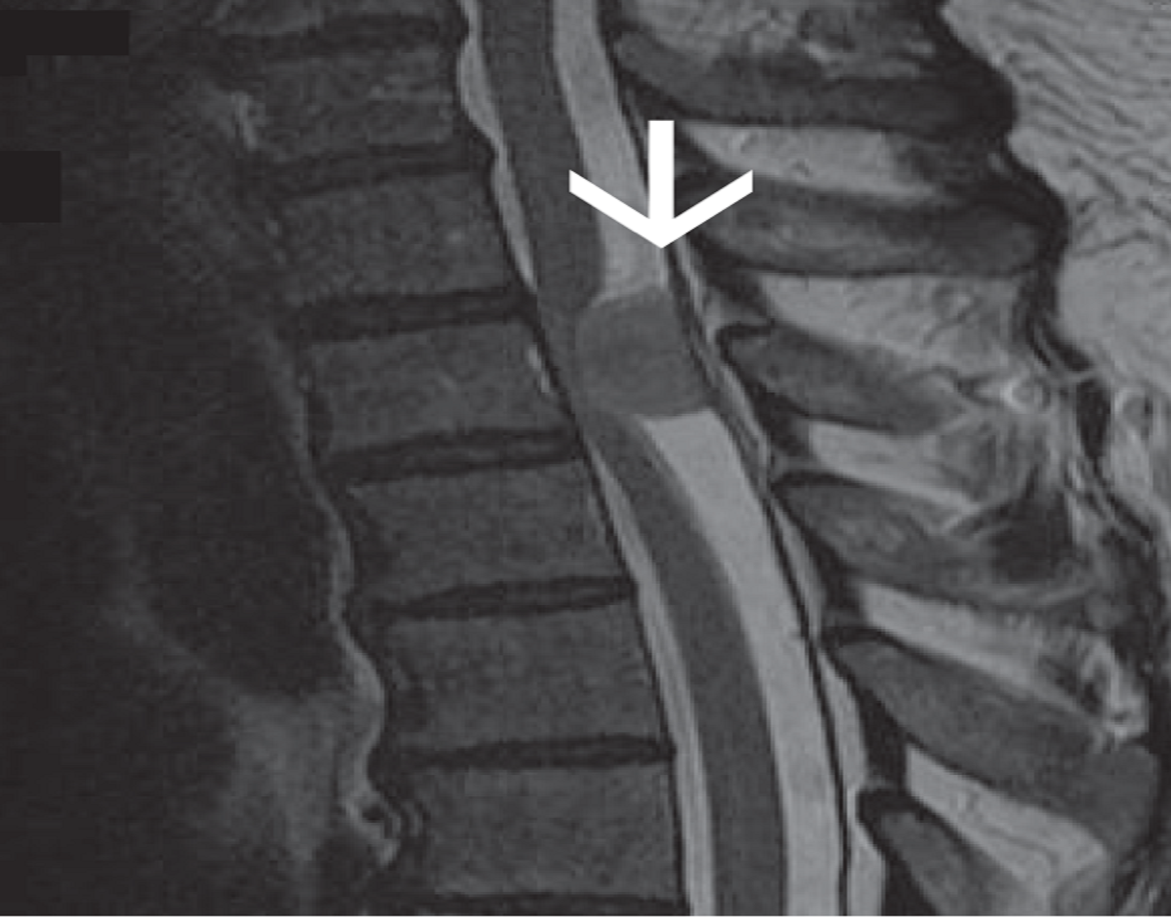 Primary Intramedullary Diffuse Large B cell Lymphoma Mimicking a Spinal Meningioma: A Case Report and Review of the Literature