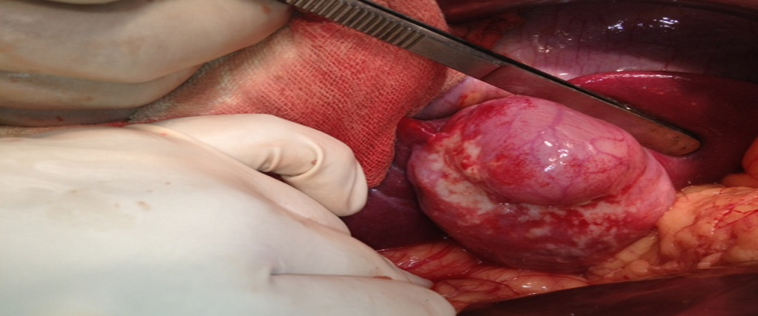 Does Bladder Cancer Pathology Matter in Prognosis and Treatment?