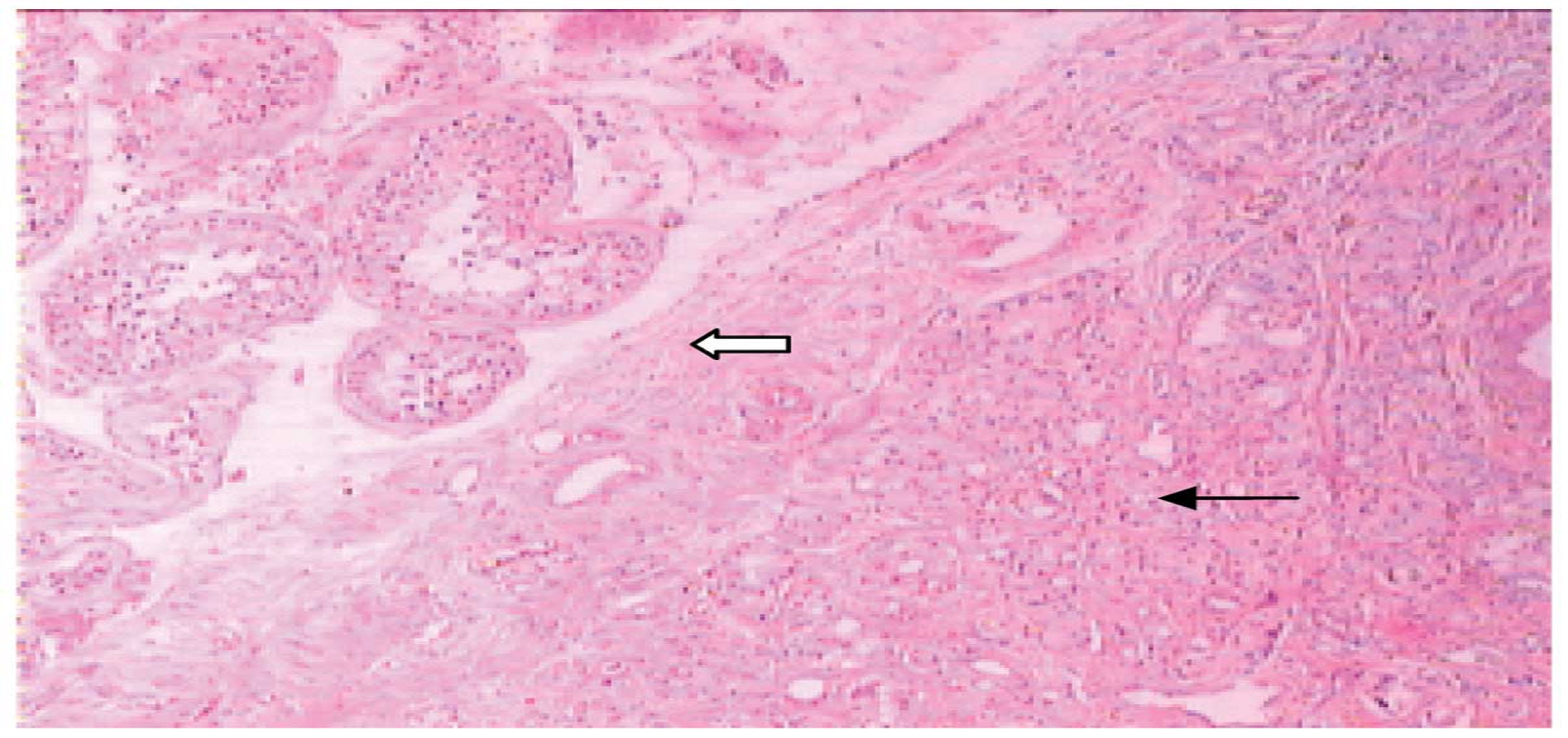 Post-Prostatectomy Radiotherapy in a Single Tertiary Institution: Outcomes Relating to Pre-Radiotherapy Prostate Specific Antigen