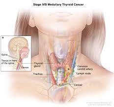Cancer Thyroid Toxicity
