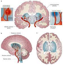 Lacunar Infarction in Old Stroke