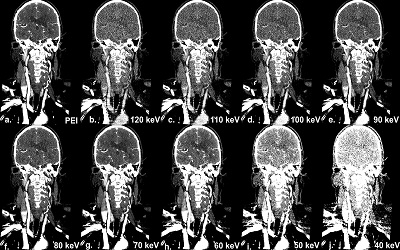 Assessment of Low Versus Standard kVp Settings in Cerebral CT Angiography for the Optimization of Contrast Medium