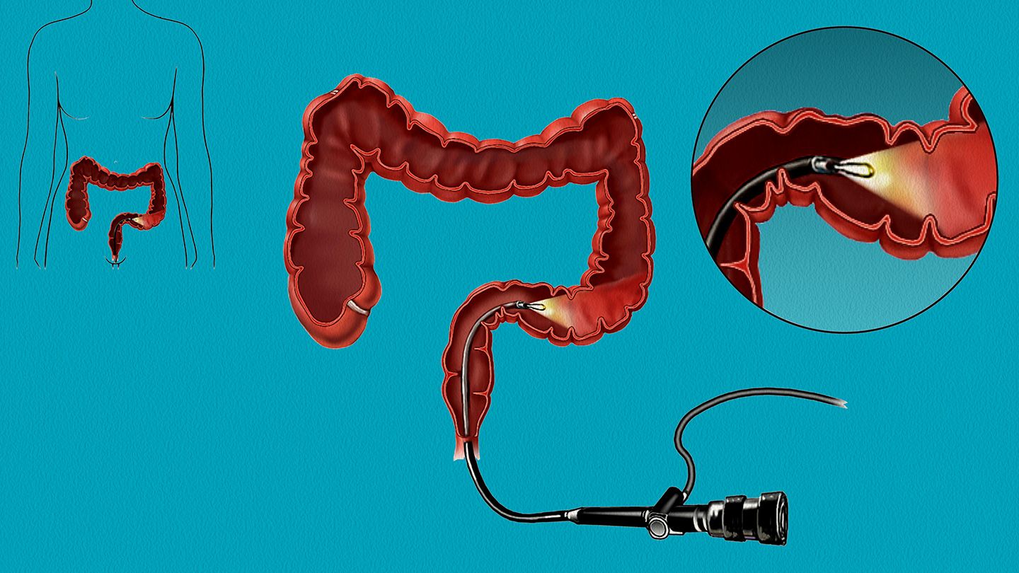 Sigmoidoscopy: Assessment of the Lower Colon Utilizing a Flimsy