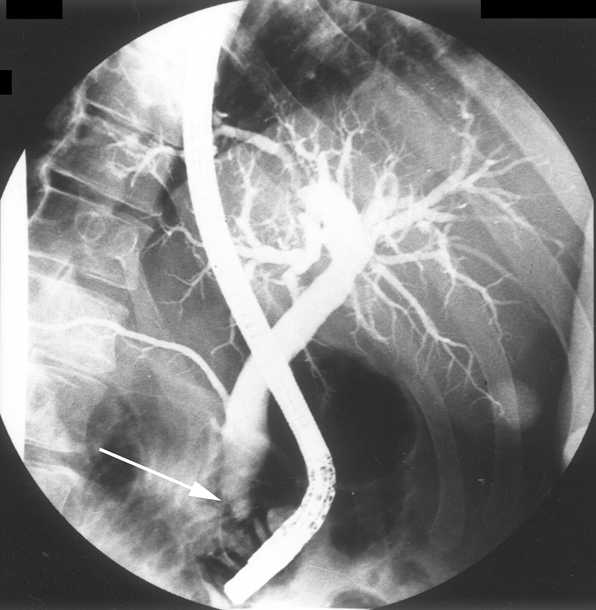 Gastric Neoplasms in Patients with Familial Adenomatous Polyposis: Endoscopic and Clinic pathologic Highlights