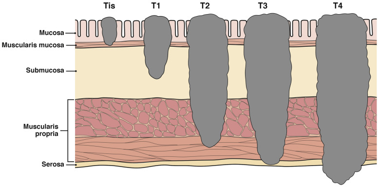 Assessment of Polypectomy Quality Signs of Huge Non-pedunculated Colorectal Polyps in a Non-expert, Entrails Malignant Growth Screening Partner