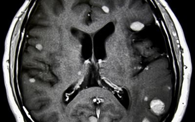 Comparison of 1.5T and 3T Prostate MR Examination using Surface Array Coils in Routine Clinical Practice