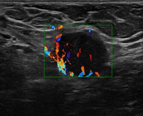 Ultrasound-Guided Axillary Lymph Node Biopsy: Retrospective Analysis