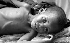 An Area at War: Alarming Malnutrition Status and its Predictors among Children Aged 6-60 Months Old in Kokang, Myanmar