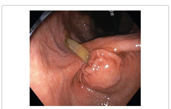 Distal Migration of Percutaneous Endoscopic Gastrostomy Tube Causing Gastric Outlet Obstruction