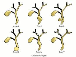 Laparoscopic Treatment of
Congenital Choledochal Cysts in
Children