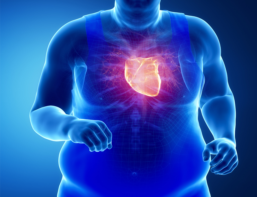 Obesity Increases Your Risk of Severe Illness from Covid19 Risk