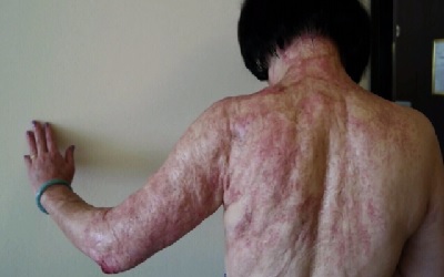 Analysis of Serum Cholinesterase Activity in Burn
Patients