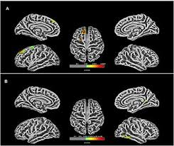 Postoperative Improvement of Brain Maturation in Infants with Congenital Heart Disease