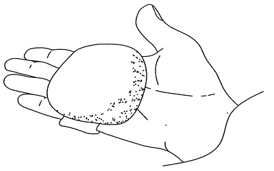 An Insulating Palmar / Plantar Muff as a Passive Thermotherapeutic Intervention for Sleep Disturbance Caused by Primary Vascular Dysregulation