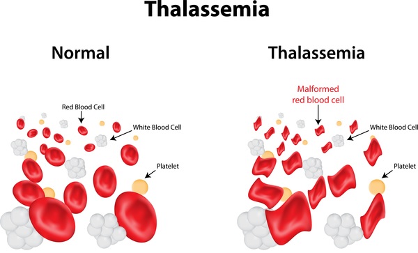 Genotype-phenotype characteristics of β thalassemia children in the Gaza Strip, Palestine