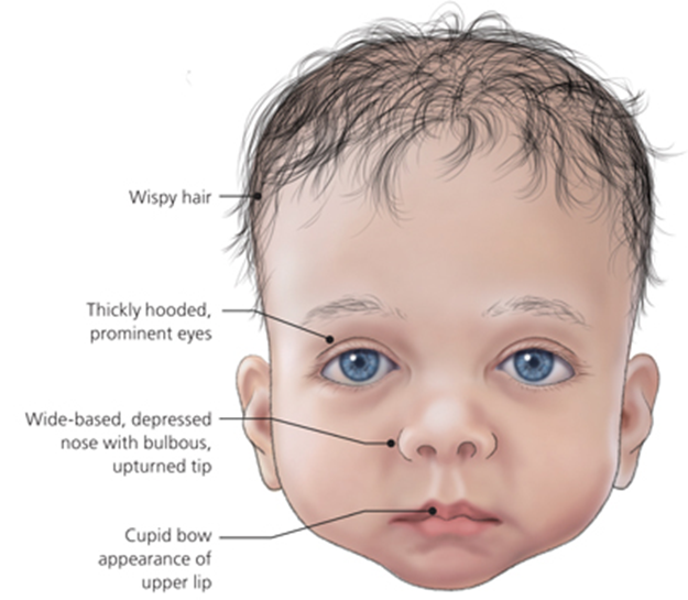 Left Ventricular Noncompaction in Noonan Syndrome