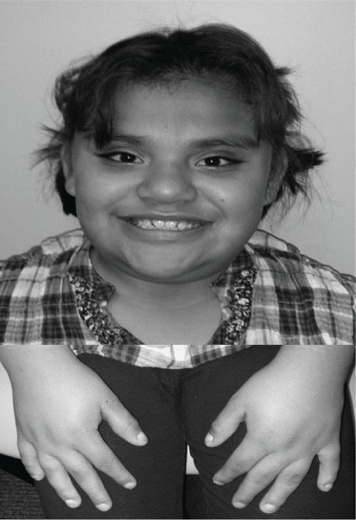 Smith-Magenis Syndrome Treated with Ramelteon and Amphetamine-dextroamphetamine: Case Report and Review of the Literature