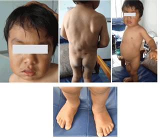 Identification of a Novel Mutation in the Human ARSB Gene on Chromosome 5q14.1 for Autosomal Recessive Mucopolysaccharidosis Type VI Patients in Southwest Colombia