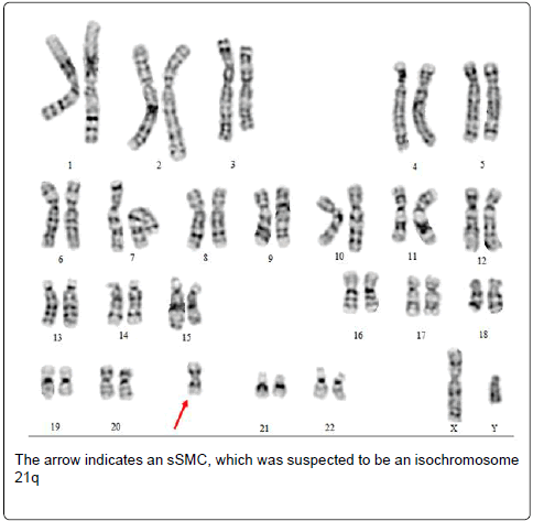 Pallister-Killian Syndrome: Undetected by Percutaneous Umbilical Blood Karyotyping and Neonatal Blood Microarray Comparative Genomic Hybridization