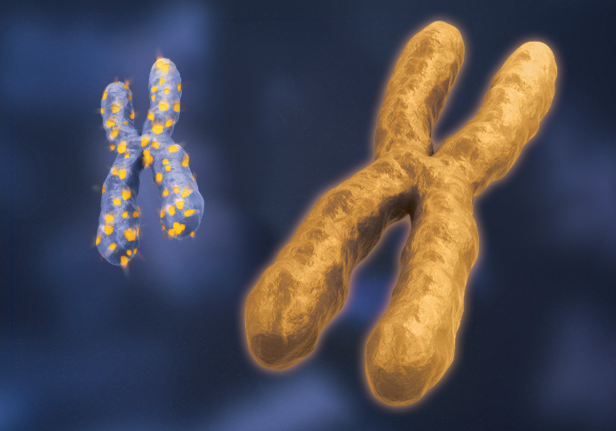 A Turner Patient Presenting Dicentric Ring X-Chromosome and Intellectual Disability