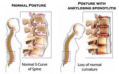 Mini Review: HLA B27 and its Immunogenetics in Ankylosing Spondylitis