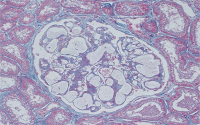 Lipoprotein Glomerulopathy: Molecular Characterization of Three Italian Patients and Literature Survey