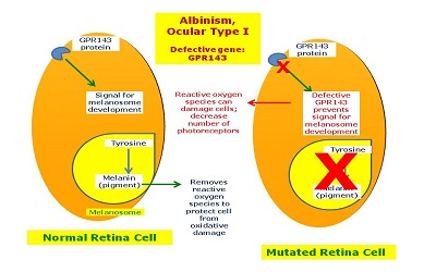 Molecular Genetic Testing for Carrier - Prenatal Diagnosis and Computational Analysis of Oculocutaneous Albinism Type 1