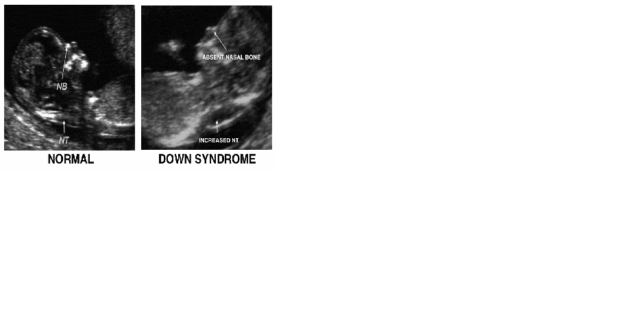 Fetuin A Concentration in the Amniotic Fluid of Fetuses with Down Syndrome