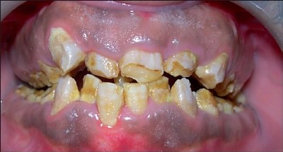 CGH Array Based Case Report of a Patient Suffering with Amelogenesis Imperfecta, Jalili Syndrome, Situs Inversus and Oligozoospermia