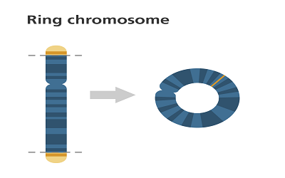 Ring14 International:Development of a National-Based Patient Association towards a “Global” Network Initiative to Fight a Chromosomal Disorder