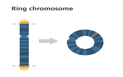 Ring14 International:Development of a National-Based Patient Association towards a â€œGlobalâ€ Network Initiative to Fight a Chromosomal Disorder