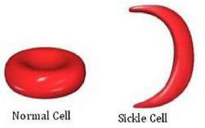 Indigenous Complimentary Health Seeking Behavior among Caregivers of Sickle Cell Disorder in Nigeria