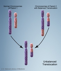 Inherited Unbalanced Chromosome from Parent with Balanced Translocation: A Case Report and Review of Literature