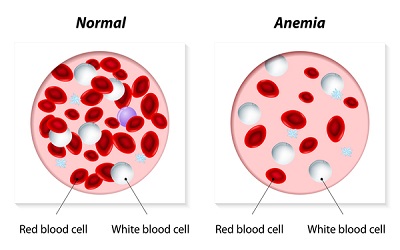 Long-Term Follow-Up of a Patient with Sitosterolemia and Hemolytic Anemia with Excellent Response to Ezetimibe