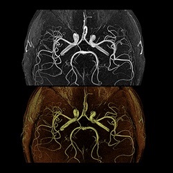 Cerebrovascular and Brain Abnormalities in Autosomal- Dominant Polycystic Kidney
Disease: Role of 3d Time-of-Flight Magnetic Resonance Angiography